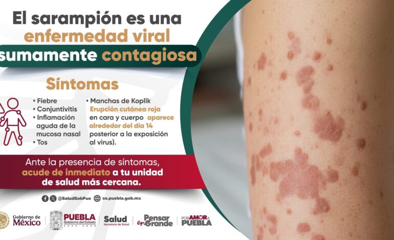 La directora de Salud Pública llama a vacunarse tras confirmarse el primer caso de sarampión en Puebla
