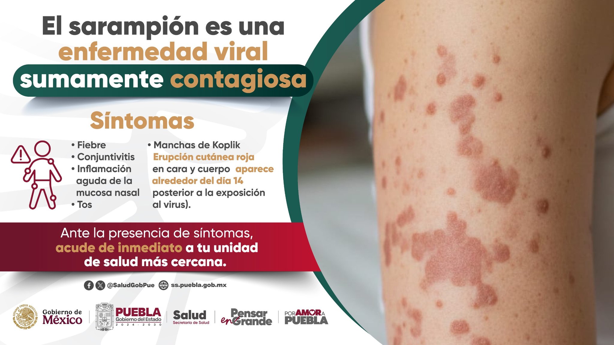 La directora de Salud Pública llama a vacunarse tras confirmarse el primer caso de sarampión en Puebla